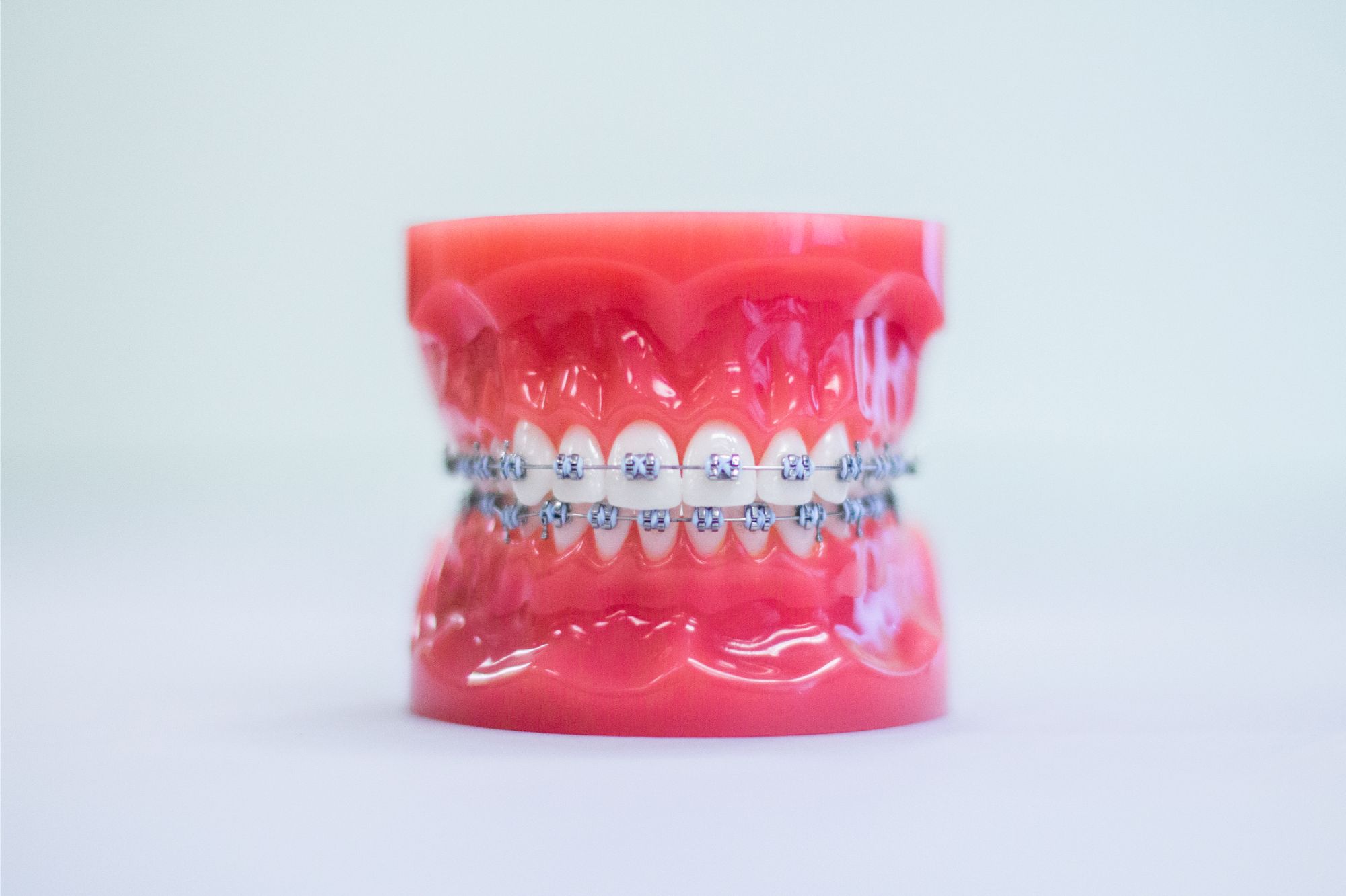 Orthodontics - Metal Braces