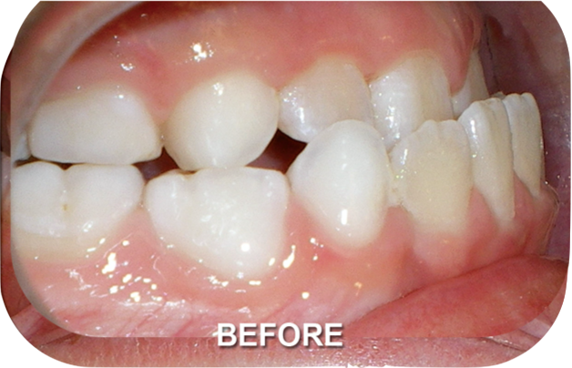 Orthodontics Treatment Class III Skeletal Before