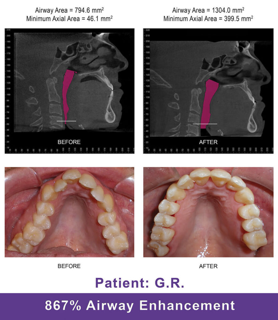 Airway Orthodontist for Your Smile