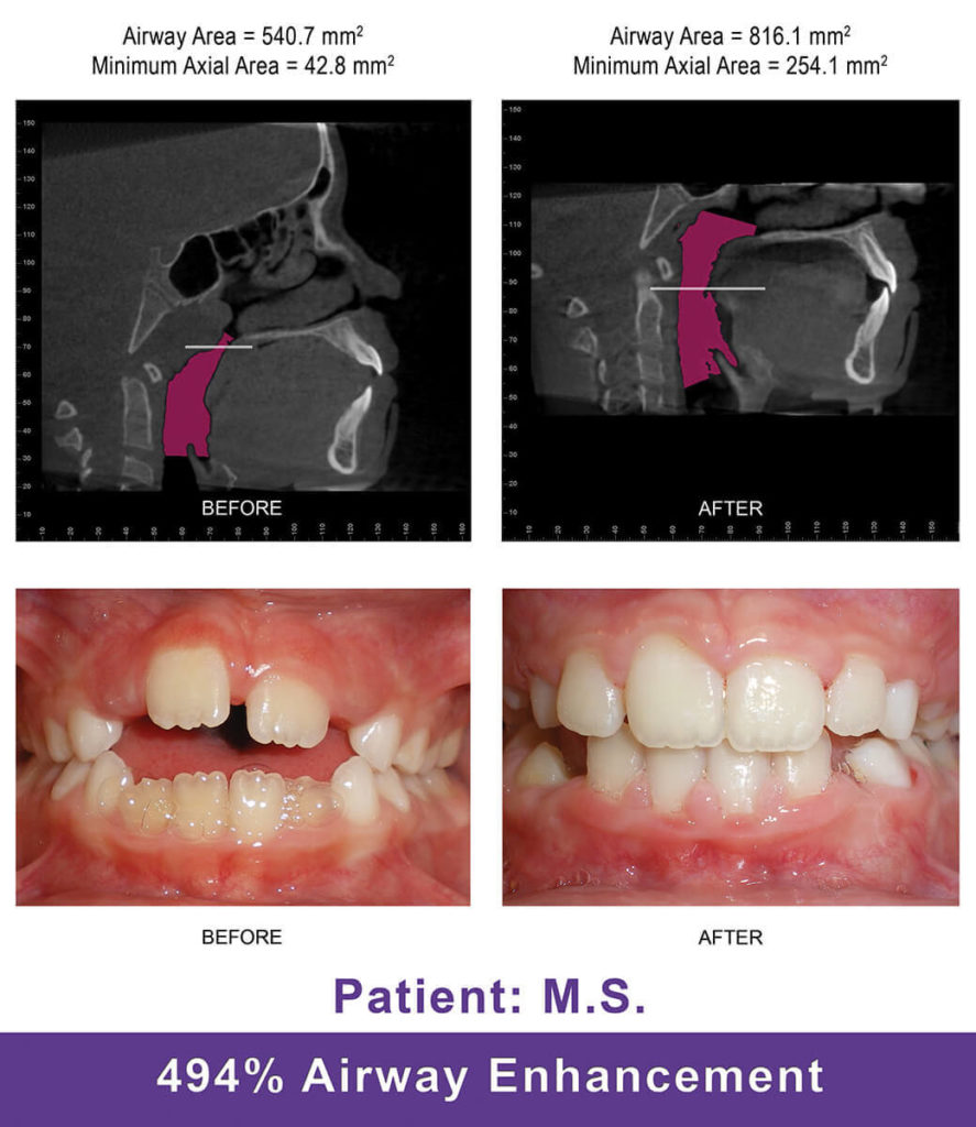 Airway Orthodontist for Your Smile